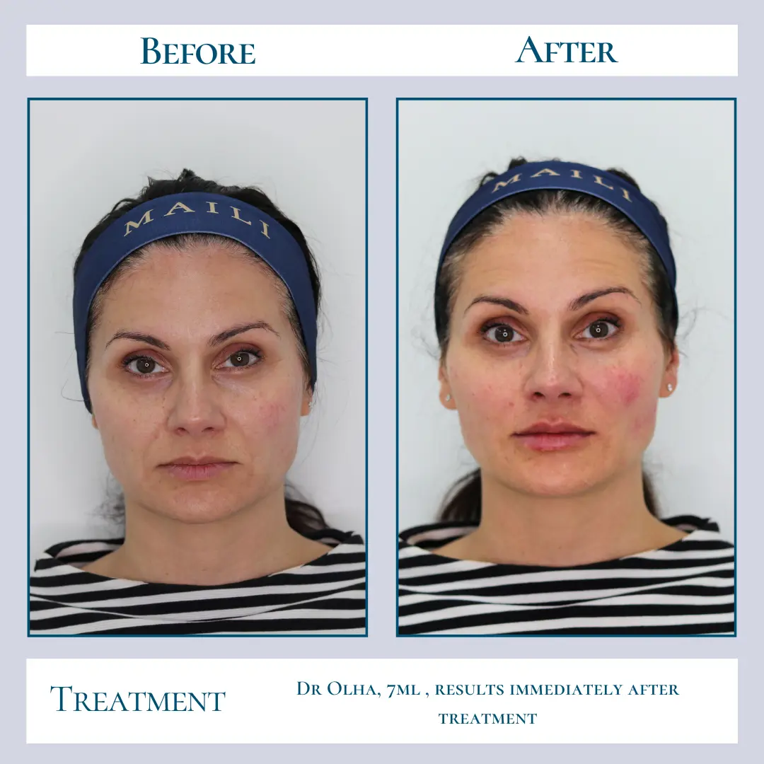 Maili Before & After