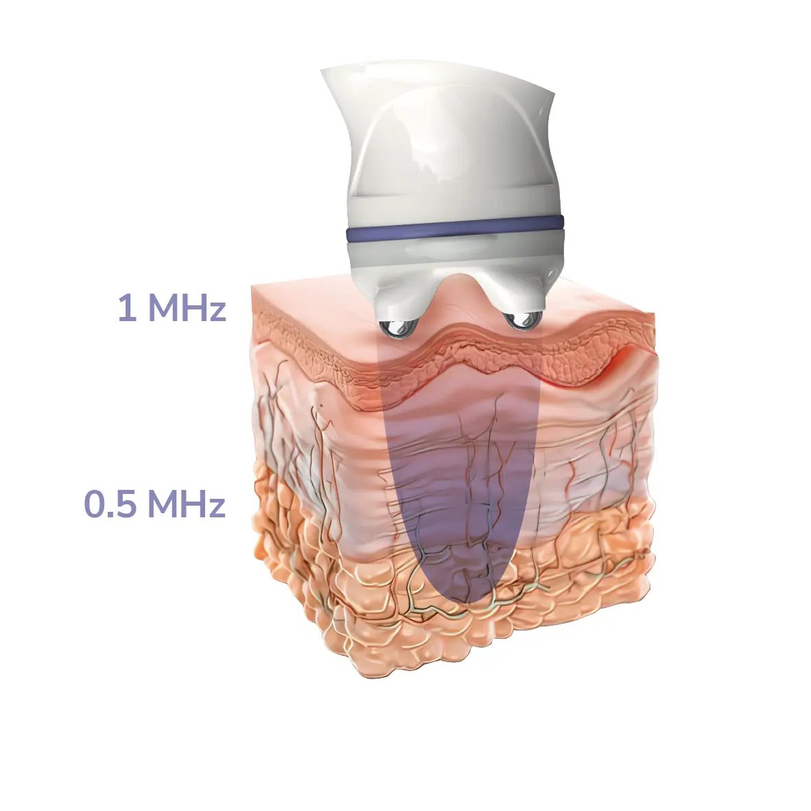 S S Bipolar RF