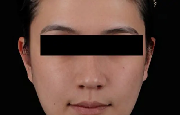 Asian Model 3 AFTER 6 MONTH