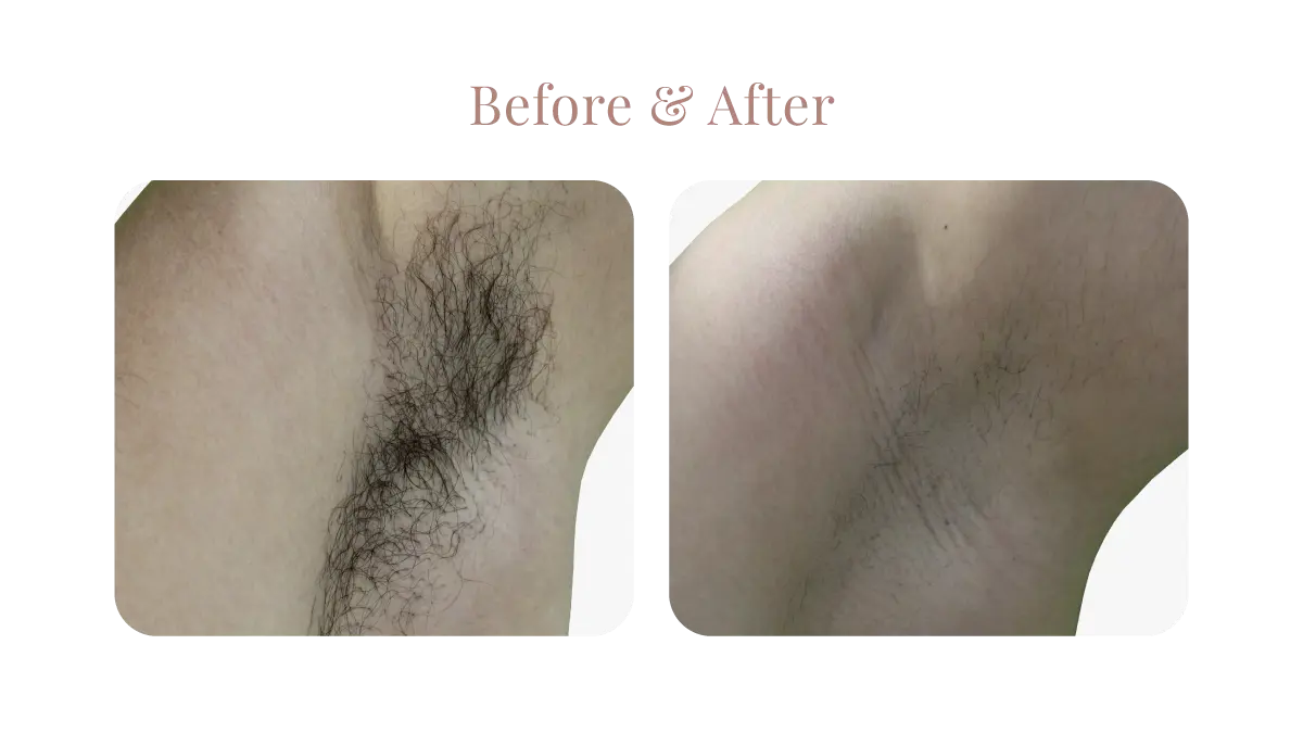 Primelase B&A 3B
