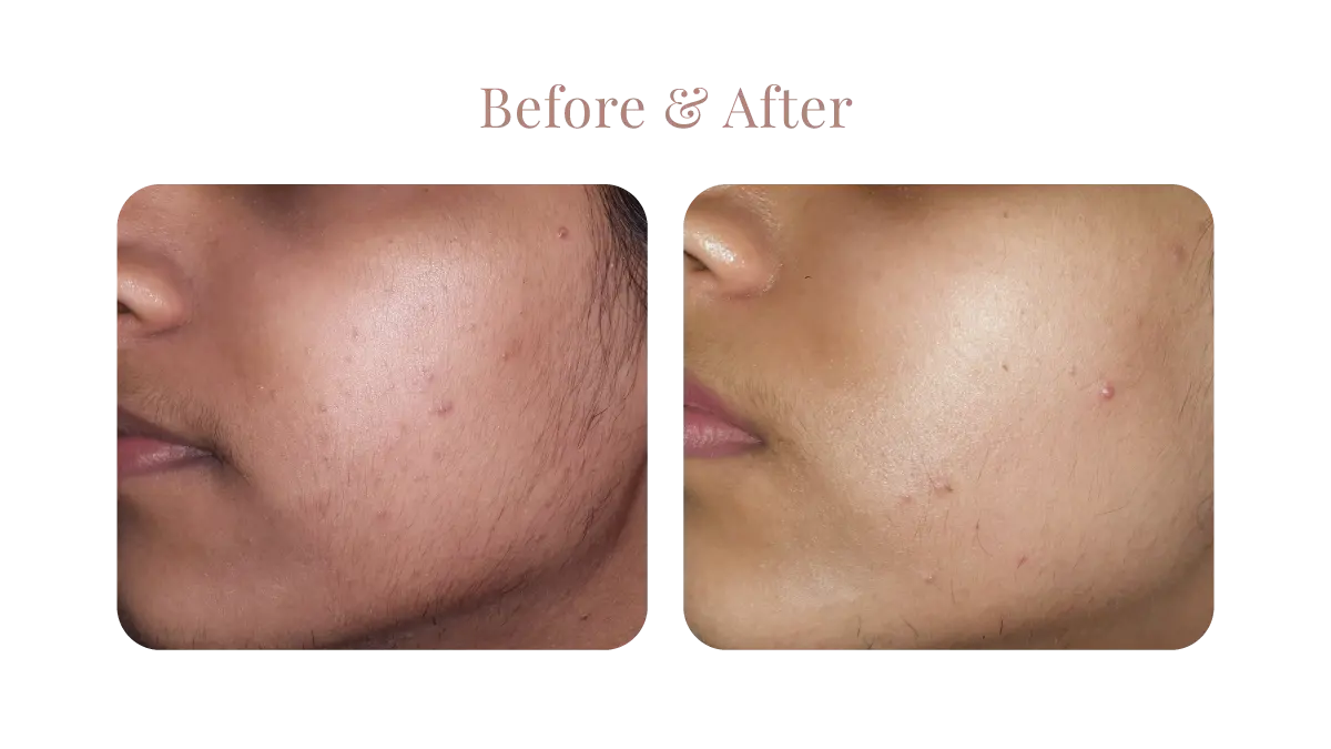 Primelase B&A 1A