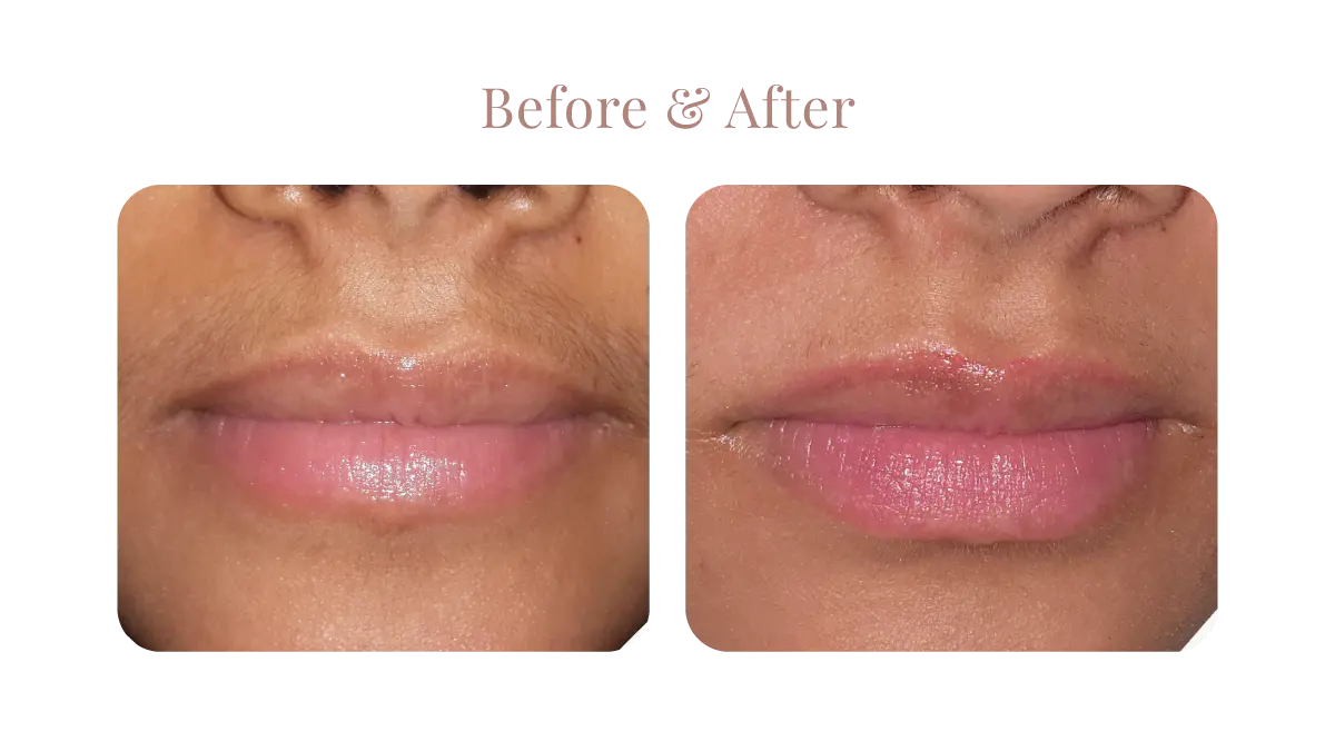 Primelase B&A 4B