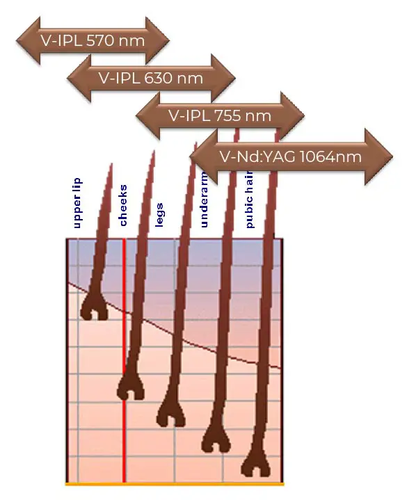 Figure 3 V30 Total Body Solution For Photo Epilation 01