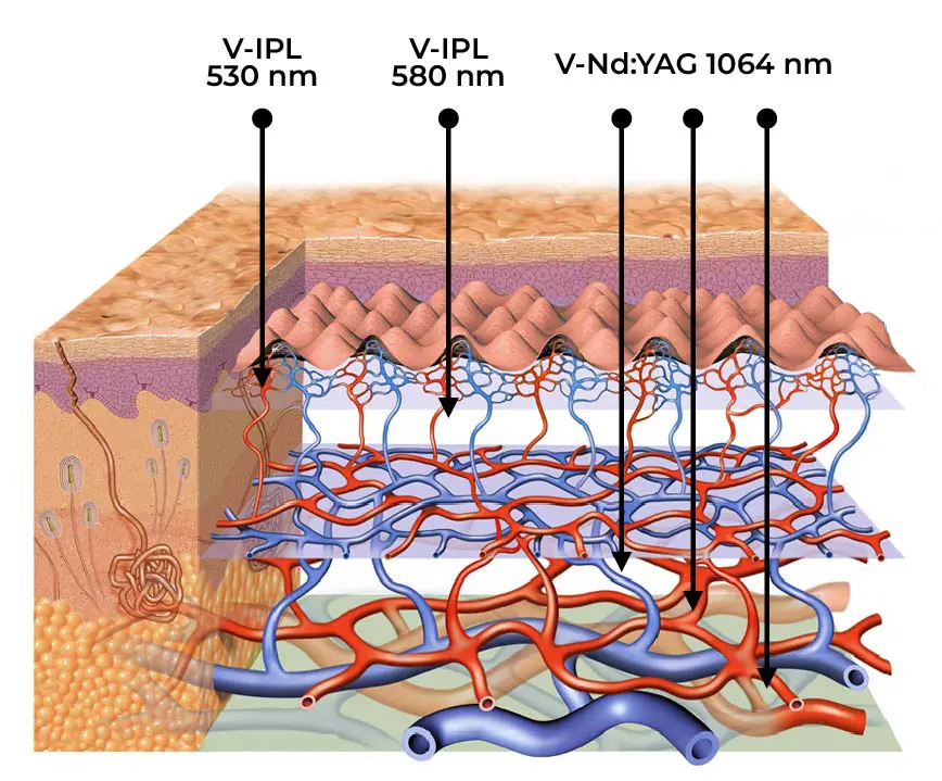 Figure 2 V30 Total Body Solution For Vascular Lesions 01