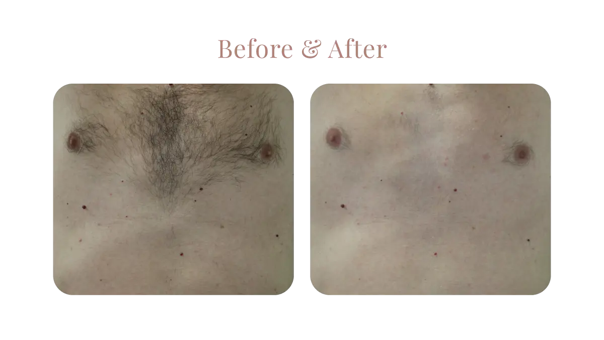 Primelase B&A 2B